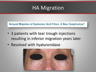 HA Migration
• 3 patients with tear trough injections
resulting in inferior migration years later
• Resolved with hyaluronidase
 