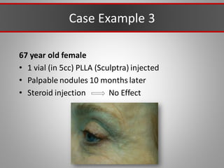 Case Example 3
67 year old female
• 1 vial (in 5cc) PLLA (Sculptra) injected
• Palpable nodules 10 months later
• Steroid injection No Effect
 