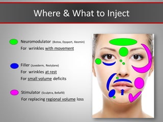 Where & What to Inject
Neuromodulator (Botox, Dysport, Xeomin)
For wrinkles with movement
Filler (Juvederm, Restylane)
For wrinkles at rest
For small volume deficits
Stimulator (Sculptra, Bellafill)
For replacing regional volume loss
 