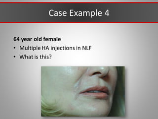 Case Example 4
64 year old female
• Multiple HA injections in NLF
• What is this?
 