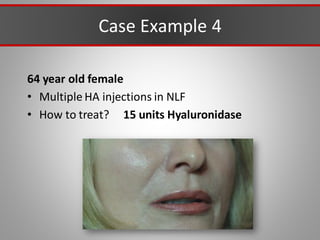 Case Example 4
64 year old female
• Multiple HA injections in NLF
• How to treat? 15 units Hyaluronidase
 