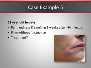 Case Example 5
51 year old female
• Pain, redness & swelling 2 weeks after HA injection
• Firm without fluctuance
• Treatment?
 