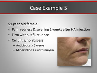 Case Example 5
51 year old female
• Pain, redness & swelling 2 weeks after HA injection
• Firm without fluctuance
• Cellulitis, no abscess
– Antibiotics x 6 weeks
– Minocycline + clarithromycin
 