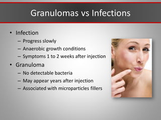 Granulomas vs Infections
• Infection
– Progress slowly
– Anaerobic growth conditions
– Symptoms 1 to 2 weeks after injection
• Granuloma
– No detectable bacteria
– May appear years after injection
– Associated with microparticles fillers
 
