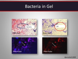 Bacteria in Gel
H&E Stain Gram Stain
PNA Probe PNA Probe
Gel
Bacteria
Bjarnsholt 2009
 