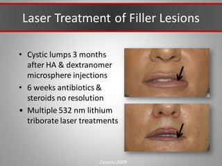 Laser Treatment of Filler Lesions
• Cystic lumps 3 months
after HA & dextranomer
microsphere injections
• 6 weeks antibiotics &
steroids no resolution
• Multiple 532 nm lithium
triborate laser treatments
Cassuto 2009
 