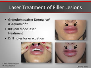 Laser Treatment of Filler Lesions
• Granulomas after Dermalive*
& Aquamid**
• 808 nm diode laser
treatment
• Drill holes for evacuation
Cassuto2009
* HA + acrylic hydrogel
** Polyacrylamide
 