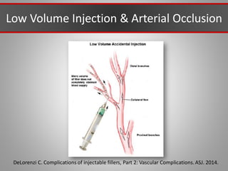DeLorenzi C. Complications of injectable fillers, Part 2: Vascular Complications.ASJ. 2014.
Low Volume Injection & Arterial Occlusion
 