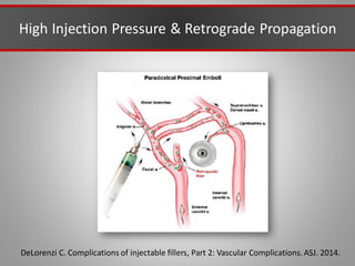DeLorenzi C. Complications of injectable fillers, Part 2: Vascular Complications.ASJ. 2014.
High Injection Pressure & Retrograde Propagation
 