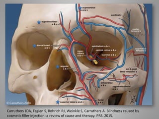 Carruthers JDA, Fagien S, Rohrich RJ, Weinkle S, Carruthers A. Blindness caused by
cosmetic filler injection: a review of cause and therapy. PRS. 2015.
 