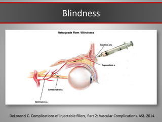 DeLorenzi C. Complications of injectable fillers, Part 2: Vascular Complications.ASJ. 2014.
Blindness
 
