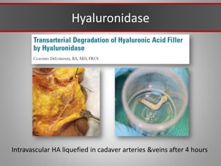 Hyaluronidase
Intravascular HA liquefied in cadaver arteries &veins after 4 hours
 