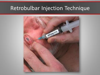 Retrobulbar Injection Technique
 