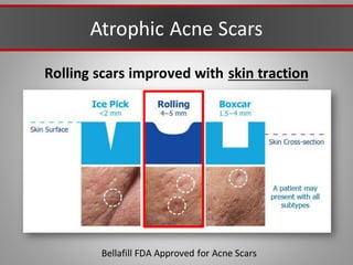 Atrophic Acne Scars
Bellafill FDA Approved for Acne Scars
Rolling scars improved with skin traction
 