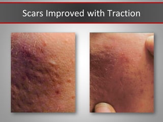Scars Improved with Traction
 
