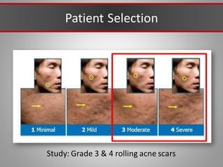 Patient Selection
Study: Grade 3 & 4 rolling acne scars
 