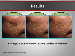 Results
Baseline Month 12
Month 6
A B
C
D
E
F
G
Only circled scars were treated
2 syringes over 2 treatment sessions total for both cheeks
 