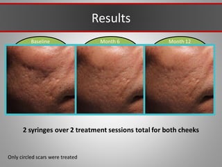 Baseline Month 12
Month 6
Results
Only circled scars were treated
2 syringes over 2 treatment sessions total for both cheeks
 