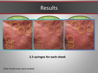 Baseline Month 12
Month 6
A
B C
D
E
Results
291
Only circled scars were treated
2.5 syringes for each cheek
 
