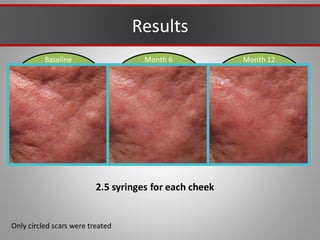 Baseline Month 12
Month 6
Results
Only circled scars were treated
2.5 syringes for each cheek
 