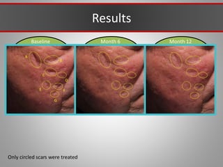 Baseline Month 12
Month 6
A
B
C
D
E F
G
Results
Only circled scars were treated
 
