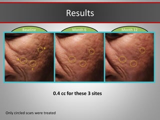 Baseline Month 12
Month 6
A
B
C
Results
Only circled scars were treated
0.4 cc for these 3 sites
 