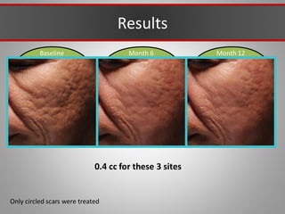 Baseline Month 12
Month 6
Results
Only circled scars were treated
0.4 cc for these 3 sites
 