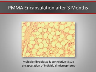 PMMA Encapsulation after 3 Months
Multiple fibroblasts & connective tissue
encapsulation of individual microspheres
 