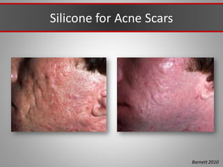 Silicone for Acne Scars
Barnett 2010
 