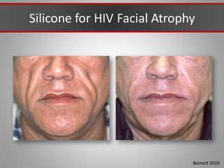 Silicone for HIV Facial Atrophy
Barnett 2010
 