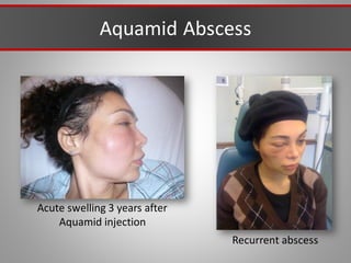 Aquamid Abscess
Acute swelling 3 years after
Aquamid injection
Recurrent abscess
 