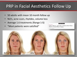 PRP in Facial Aesthetics Follow Up
• 50 adults with mean 10 month follow up
• NLFs, acne scars, rhytides, volume loss
• Average 1.6 treatments (Range 1-5)
• “Most patients were satisfied”
Before NFL Injection After 3 months After 12 months
 