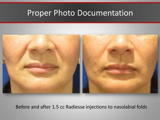 Proper Photo Documentation
Before and after 1.5 cc Radiesse injections to nasolabial folds
 