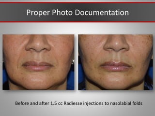 Proper Photo Documentation
Before and after 1.5 cc Radiesse injections to nasolabial folds
 