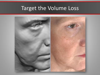 Target the Volume Loss
 