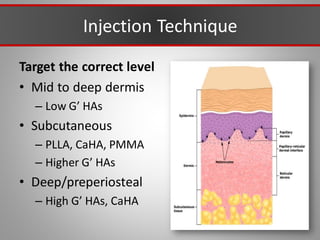 Injection Technique
Target the correct level
• Mid to deep dermis
– Low G’ HAs
• Subcutaneous
– PLLA, CaHA, PMMA
– Higher G’ HAs
• Deep/preperiosteal
– High G’ HAs, CaHA
 