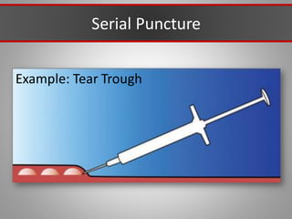 Serial Puncture
Example: Tear Trough
 
