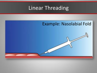 Linear Threading
Example: Nasolabial Fold
 