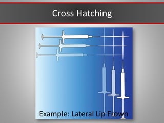 Cross Hatching
Example: Lateral Lip Frown
 