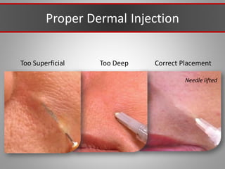 Correct Placement
Too Deep
Too Superficial
Proper Dermal Injection
Needle lifted
 