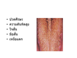 • ปวดศีรษะ
• ความดันหิตสูง
• ใจสั่น
• มือสั่น
• เหงื่อแตก
 