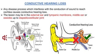 CONDUCTIVE HEARING LOSS
 Any disease process which interferes with the conduction of sound to reach
cochlea causes conductive hearing loss.
 The lesion may lie in the external ear and tympanic membrane, middle ear or
ossicles up to stapediovestibular joint
 