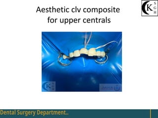 Aesthetic clv composite
for upper centrals
 