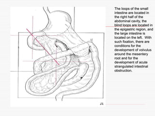 Intussusception | PPT
