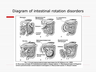 Reverse Rotation Intestine Intussusception | PPT