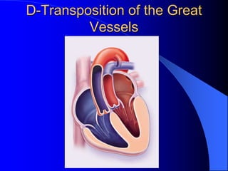 D-Transposition of the Great
Vessels
 