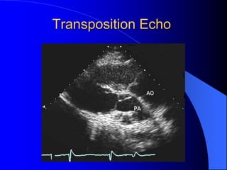 Transposition Echo
 