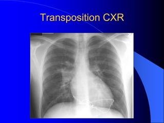 Transposition CXR
 