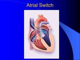 Atrial Switch
 