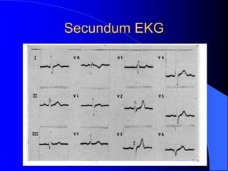 Secundum EKG
 